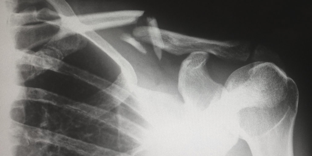 Injury Compensation Claims - KMC Legal Bathurst